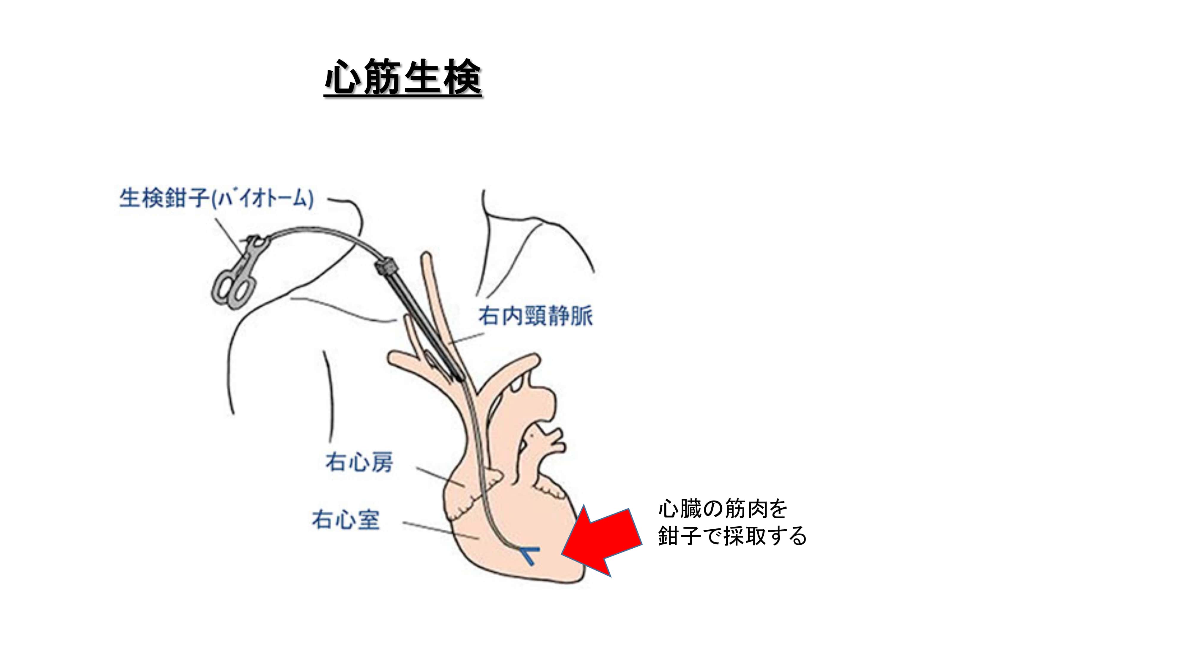 検査 心臓 カテーテル