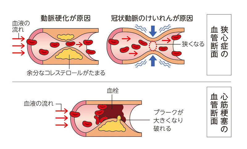 梗塞 心筋