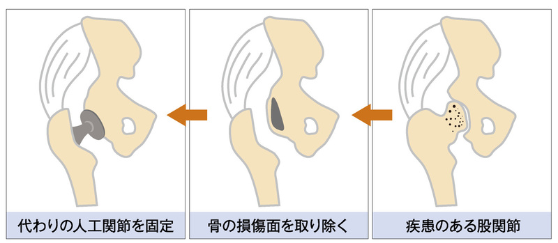 女性に多い股関節の痛み それは 変形性股関節症 かもしれません せいてつlab 社会医療法人 製鉄記念八幡病院