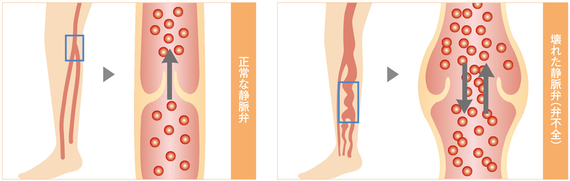 足がむくんだり 血管がボコボコふくれていませんか 下肢静脈瘤 せいてつlab 社会医療法人 製鉄記念八幡病院