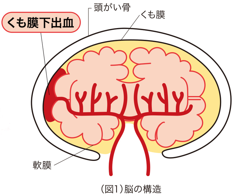 原因 くも膜 下 出血