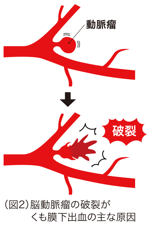 くも膜 下 出血 意識 不明 何 日