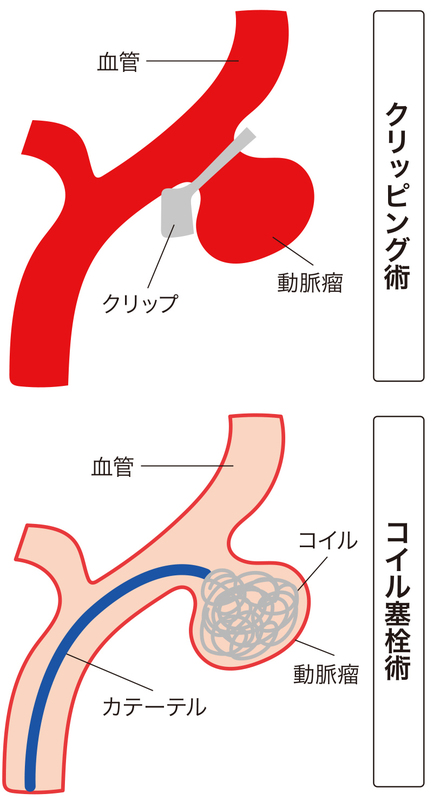 働き盛りの40歳代から増える くも膜下出血 せいてつlab 社会医療法人 製鉄記念八幡病院