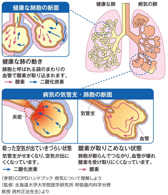 ある ある copd