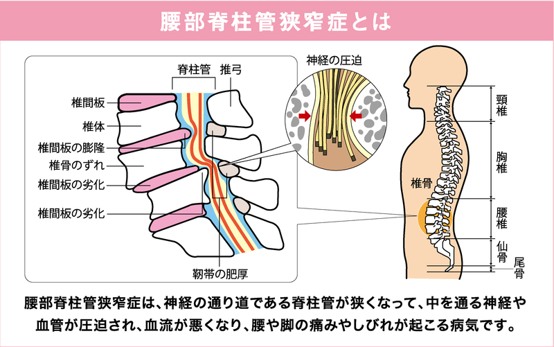 管 と は 脊柱 狭窄 症