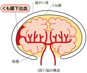 働き盛りの40歳代から増える「くも膜下出血」①